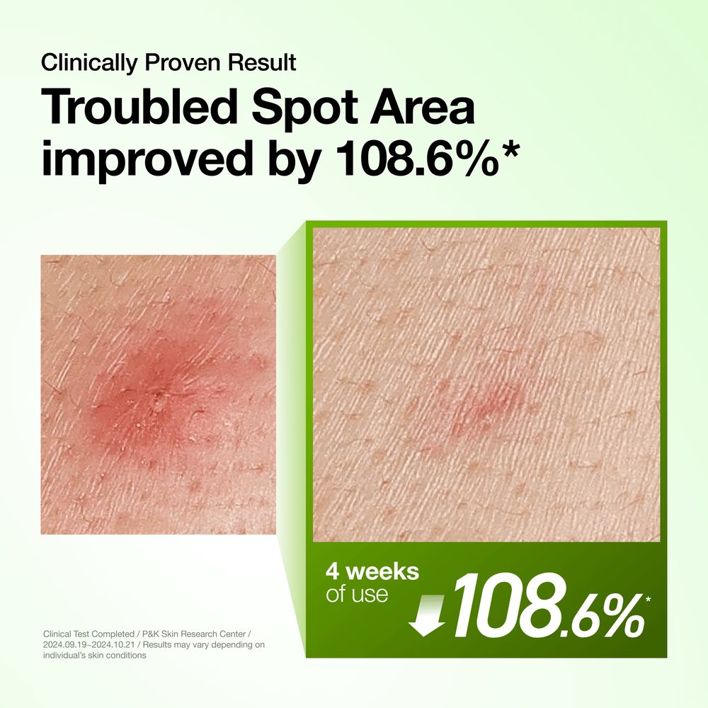 Anua Azelaic Acid 10 Hyaluron Redness Soothing Serum 30ml – før og etter